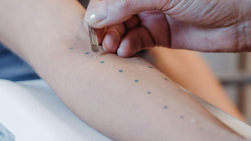 Prick-Test, bei dem potenzielle Allergene als Tropfen auf dem Arm eines Patienten getestet werden.